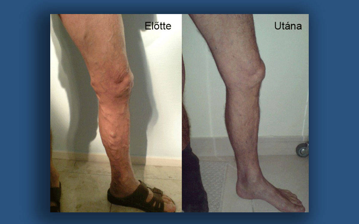 visszér 30 éves férfiaknál a lábak bőrének hiperpigmentációja visszér
