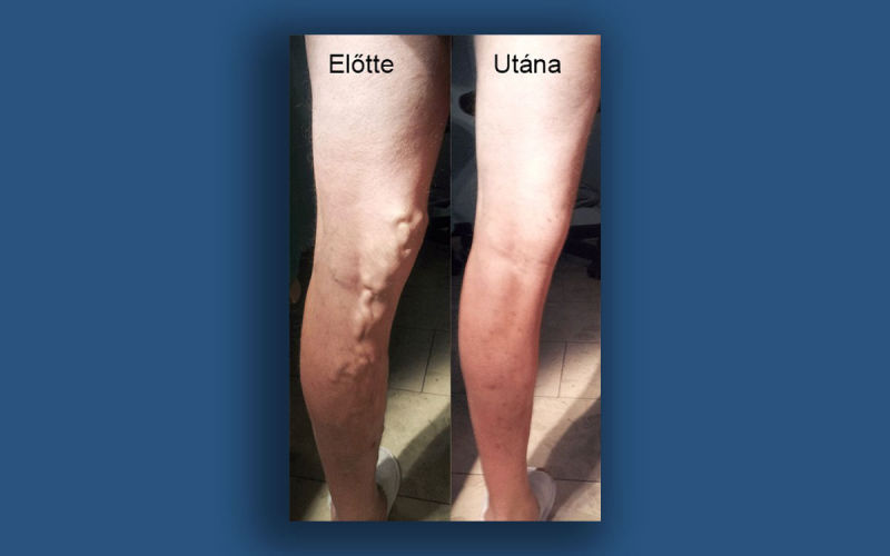 Lábvisszerek elzárása lézerrel - Betegtájékoztató | Elite Clinic