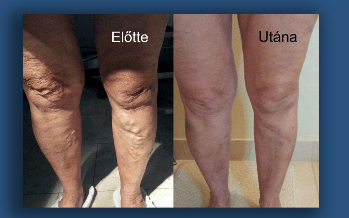 visszér etiológia patogenezis kezelés visszér a lábon férfiaknál tünetek
